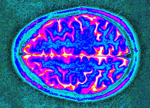 MRT-Bild des Gehirns: Schnittbildaufnahme - Foto: © Prof. Dr. Hartmut Göbel, www.schmerzklinik.de)